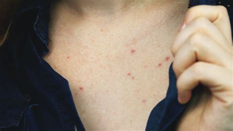 How To Get Rid Of Chest Acne Everything You Need To Know Marie Claire Uk