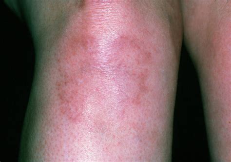 Systemic Lupus Erythematosus Rash On Womans Leg Photograph By Dr P