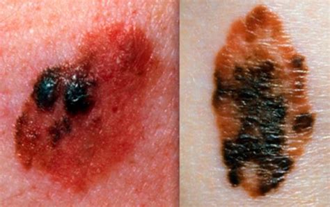 Mole On Arm Meaning Pictures Raised Swollen Painful Cancer Mole