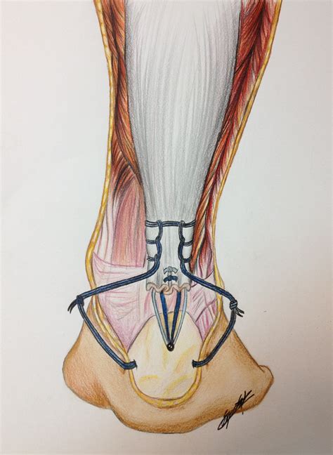 Primary Repair Of Achilles Tendon Avulsions Presentation Of A Novel Technique And Its