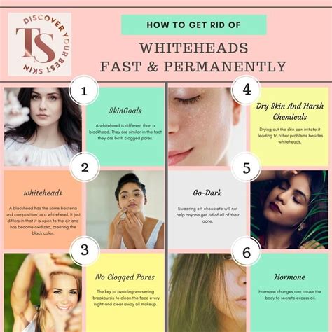 How To Get Rid Of Whiteheads Fast And Permanently How To Get Rid Of