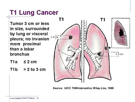 Lung Cancer Tnm Staging Chart