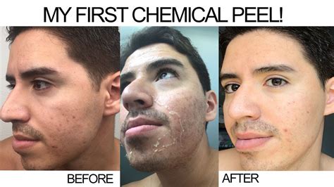 My First Chemical Peel Tca Chemical Peel Before And After Of My