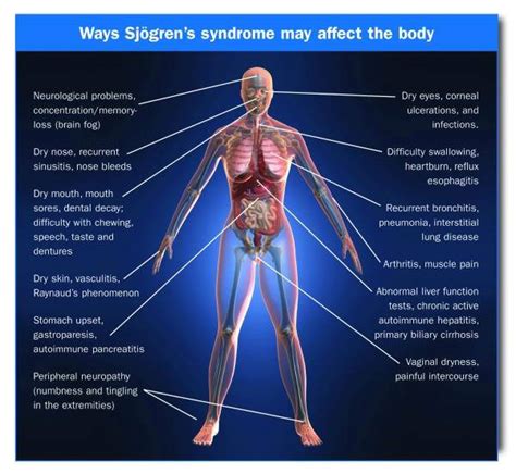 Sjogrens Syndrome What Are The Early Signs And Symptoms Of Sjogrens