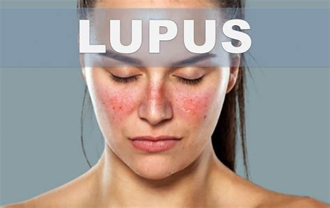 Remedios Caseros Para El Lupus Como Combatir El Lupus Naturalmente