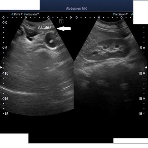 Ultrasound Abdomen And Pelvis Showing Gross Ascites With Post Partum