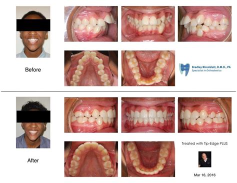 Protruded And Crowded Teeth Aligned With Braces And Extractions