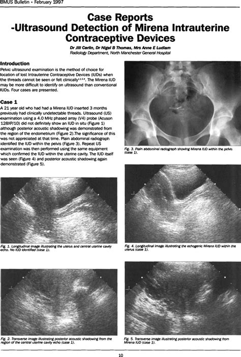 Case Reports Ultrasound Detection Of Mirena Intrauterine Contraceptive Devices Jill Carlin