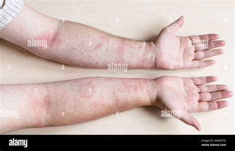 Sample Of Allergic Contact Dermatitis Male Arms Infected By Skin
