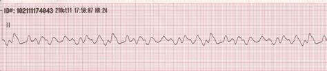 Pediatric Pulseless Ventricular Tachycardia Vt And Ventricular