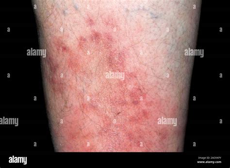 Red And Inflamed Shin Of The Leg In A 53 Year Old Male Patient Showing