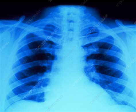 Chest X Ray Showing Normal Lungs And Heart Stock Image P5900134