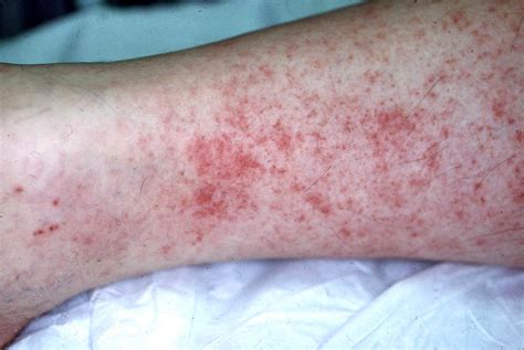The following are the most common symptoms of rmsf Rocky Mountain Spotted Fever - The Clinical Advisor