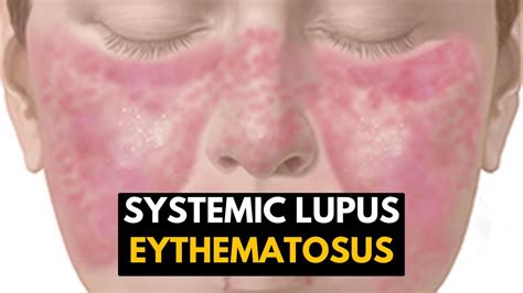 Systemic Lupus Eythematosus Sle Causes Signs And Symptoms