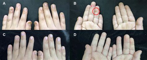 Treatment Of Periungual Warts In The Patient With Local Hyperthermia