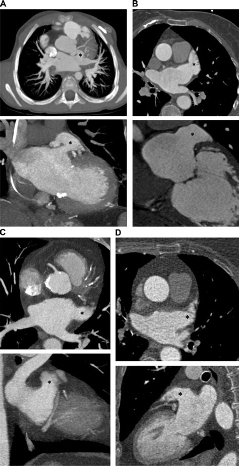 Cacti and cactuses are the plural form of cactus. CT imaging for left atrial appendage closure: A review and ...