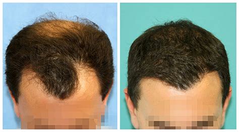 Hair Transplant 3 Months Post Surgery Results Before And After Hair