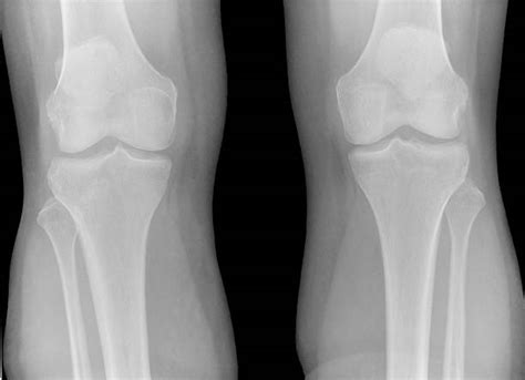 Normal Knee X Ray Views
