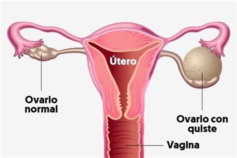 quistes en los ovarios síntomas por qué salen tipos y tratamiento tua saúde