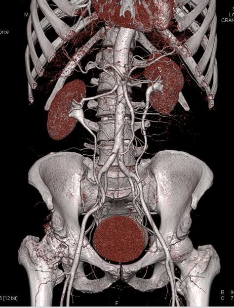 Ct Urogram With Mild Medial Positioning Of The Ureters