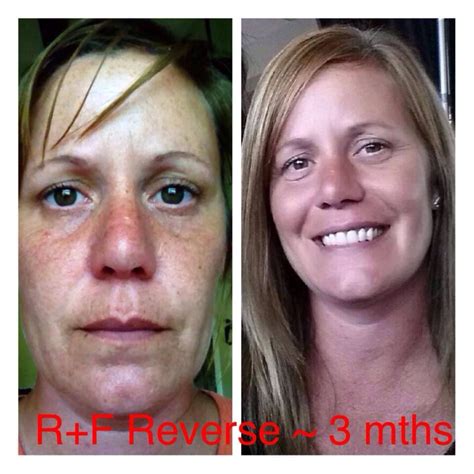 Wow Check Out Natalies Amazing Results After Using Rodan Fields