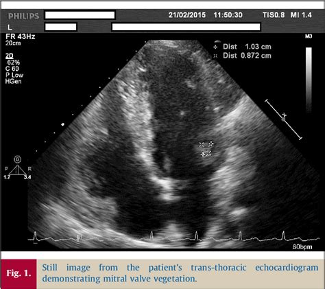 Figure 1 From Infective Endocarditis In A Patient With Atopic