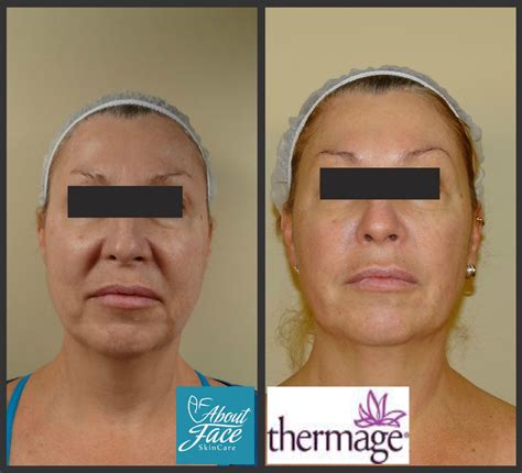 Syawa Nigma Skin Tightening Treatment