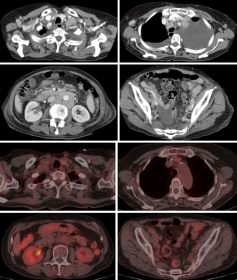 Figure1ct Images At The Diagnosis A Ct Shows Multiple Download