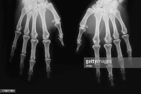 Arthritis Hand Xray Photos And Premium High Res Pictures Getty Images