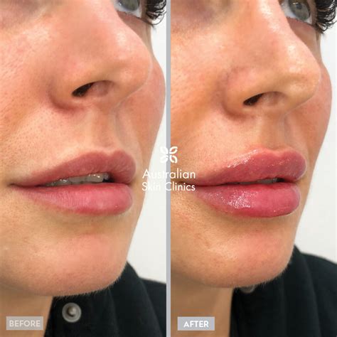 Lip Filler Injections Australian Skin Clinics
