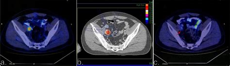 Radiation Therapy Lymph Nodes Groin All About Radiation