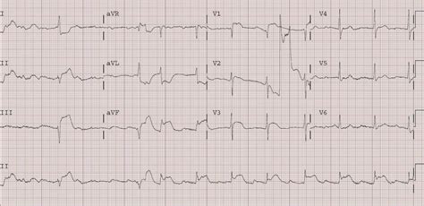 Cardiac arrest survivors with preserved 46.richter s. Dr. Smith's ECG Blog: Cardiac Arrest, Ventricular ...