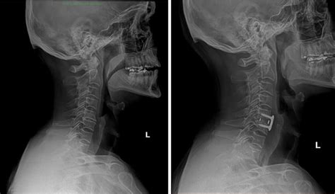 Discectomy Before And After