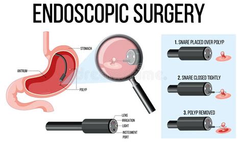 Diagram Showing Endoscopic Surgery Stock Vector Illustration Of