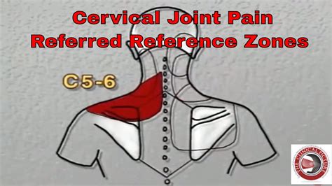 NECK PAIN DDx Cervical Facet Syndrome Referred Pain Patterns YouTube