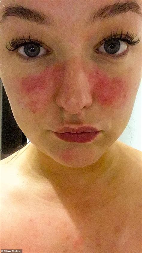 Rosacea Sufferer Claims £1995 Cream Made From Capers Calmed Skin Down