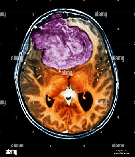 O Que é Um Tumor Cerebral