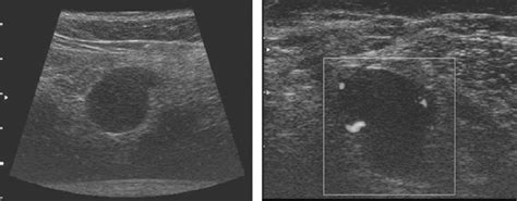 Ultrasound Representation Of A Metastatic Lymph Node Of The Left Axilla
