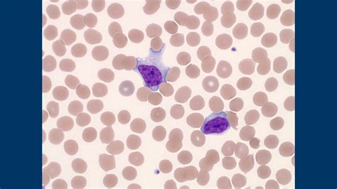 Downey Cells Reactive Lymphocytes In Monoinfectious Mononucleosis