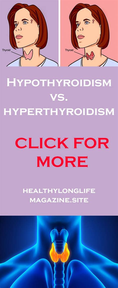 Hypothyroidism Vs Hyperthyroidism Hypothyroidism Hyperthyroidism