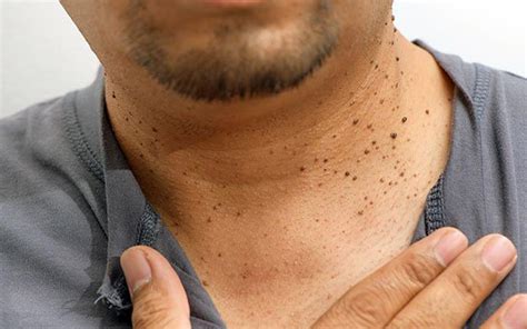 skin tags and its causes dr walia s skin and laser clinic