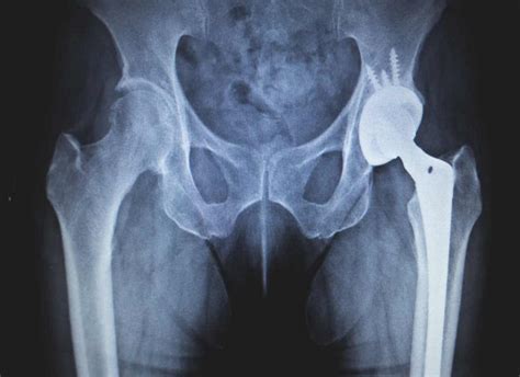 Hip Replacement Operational Procedure Docopd