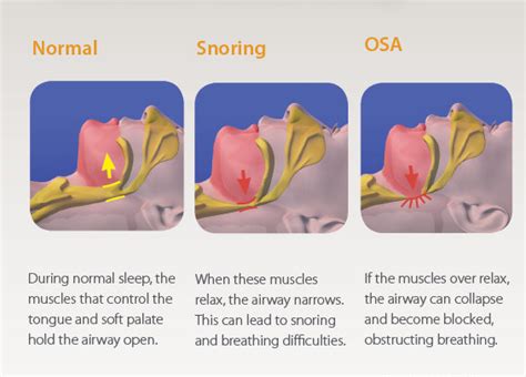 Obstructive Sleep Apnoea And Snoring Bondi Junction Dental