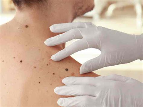 A Guide To Skin Cancers Saga