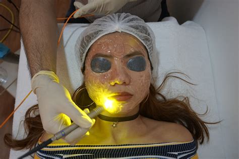 Laser For Acne Dual Yellow Laser Skin Gym Ss2 J And D Learn To Blog