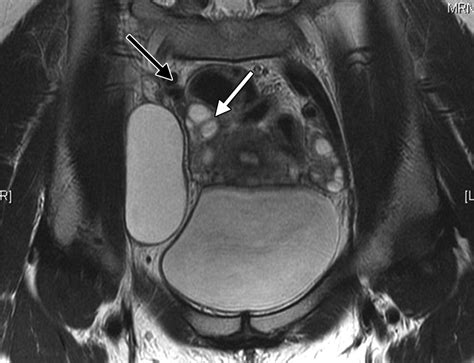 Nonovarian Cystic Lesions Of The Pelvis Radiographics
