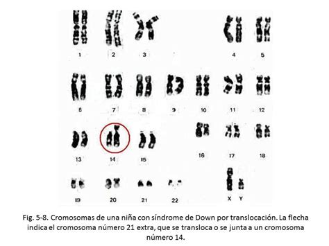 Sindrome De Down Por Translocação