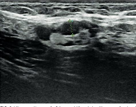 Pdf Unilateral Axillary Lymphadenopathy After The Inactivated Sarscov