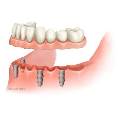How much does full mouth dental implants cost? How much do dental implants cost?