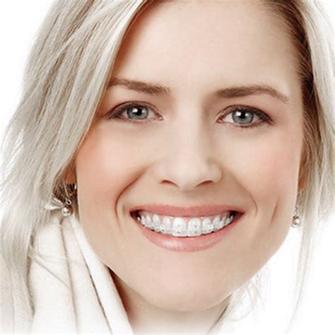 Self-ligating brackets: In-Ovation (esthetic - one jaw) - Dental center 